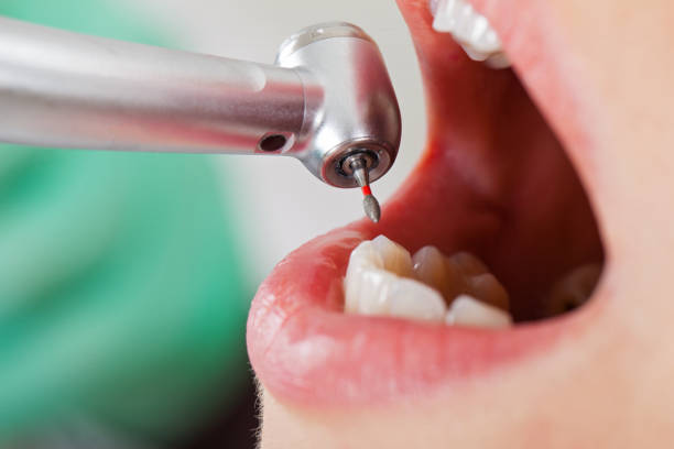 Best Emergency Dentist for Lost Fillings or Crowns in Tulare, CA